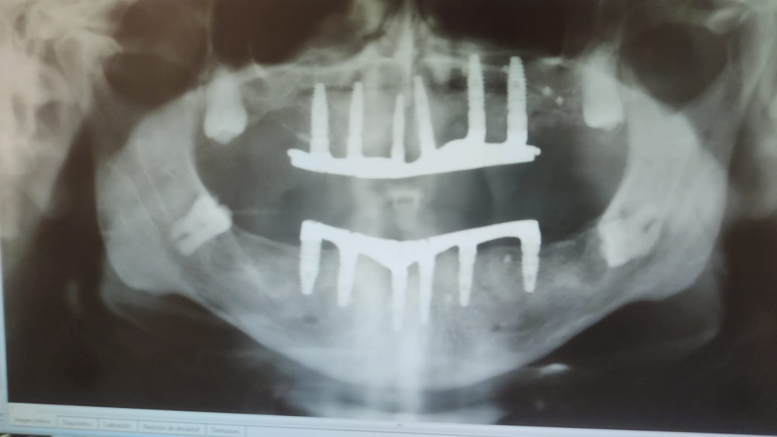 implants Sebas